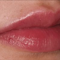 Smart values for the best Lip Filling Options