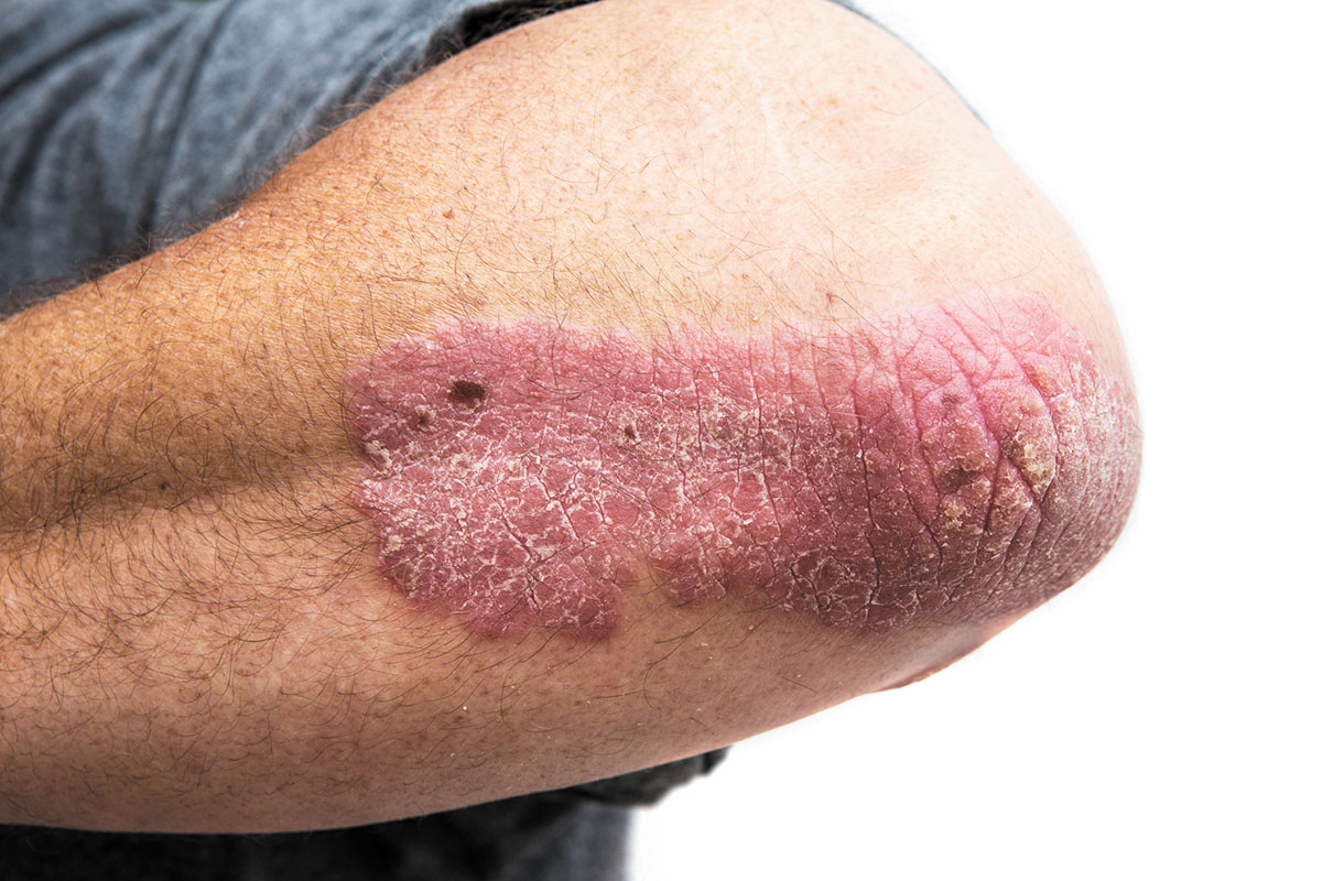 6 Common Reasons for the Spread of Psoriasis and How to Prevent The Spread